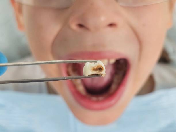 Best Emergency Treatment for Dental Infections or Abscesses in Humboldt, TN